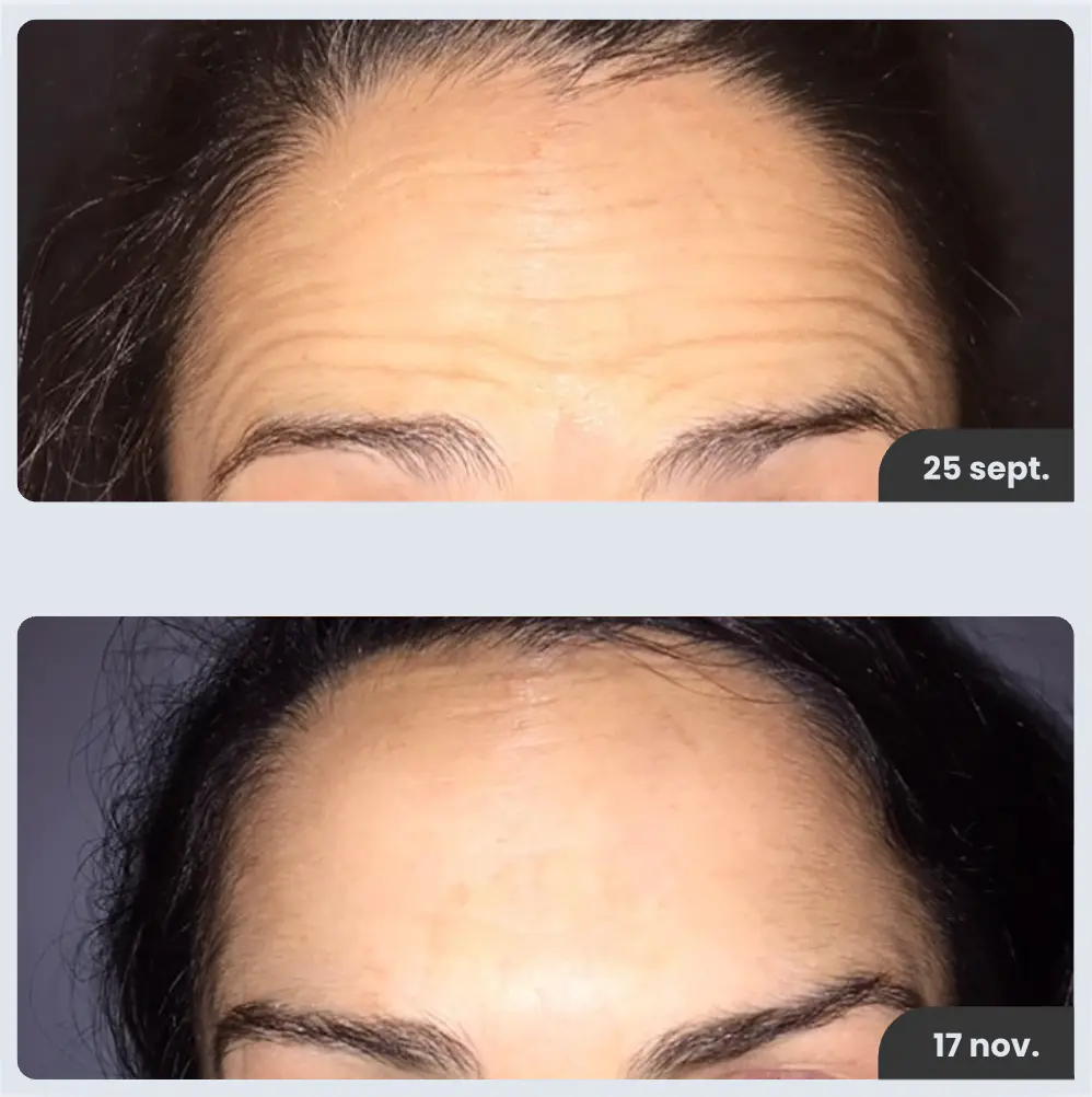 Lifting Inmediato | Sin Agujas